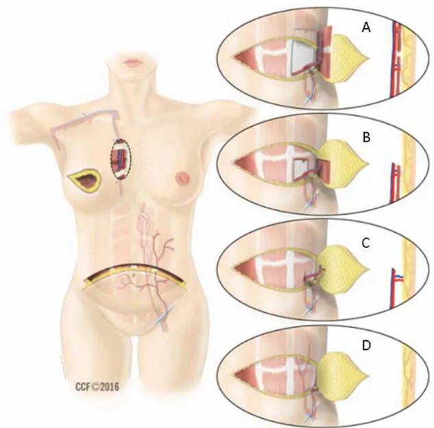 FIGURA  2:  Ilustração  dos  diferentes  tipos  de  retalhos  microcirúrgicos  da  parede  abdominal