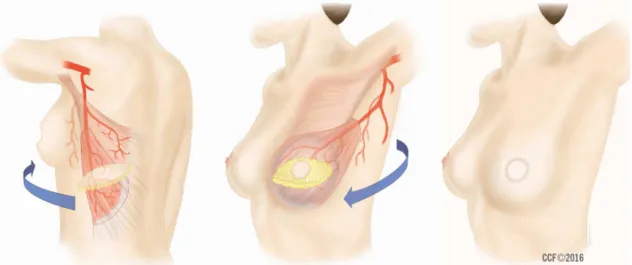 FIGURA 3: Ilustração do retalho pediculado do músculo grande dorsal associado a  implante mamário