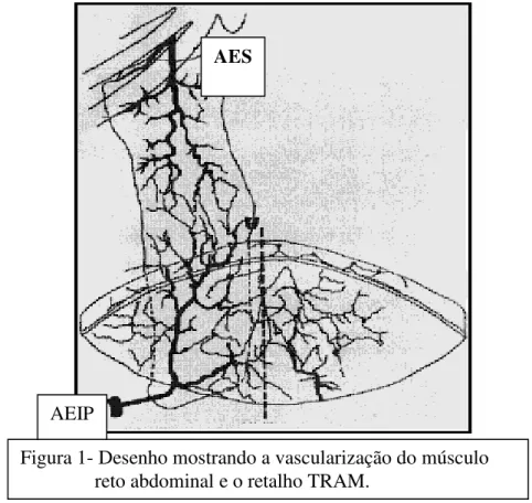 Figura 1- Desenho mostrando a vascularização do músculo                  reto abdominal e o retalho TRAM