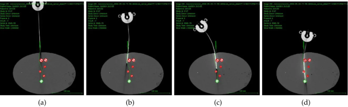 Figure 1.4: Sequence of CT images during a needle insertion with base manipulation steering (courtesy of Guide-X Ltd.).