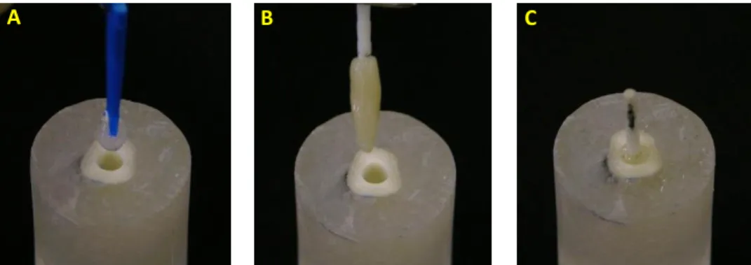 Figura  5  –   A)  Lubrificação  do  preparo  do  canal  radicular  com  gel  lubrificante  hidrossolúvel