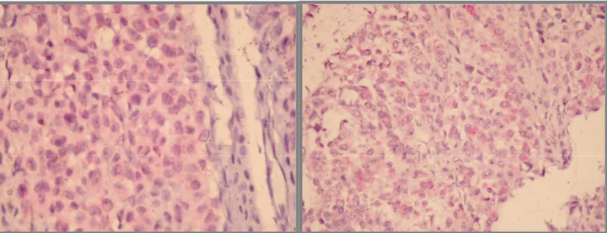 Figura 16. Imagem fotográfica das lâminas de TMA para estudo da expressão de Bcl2 em nevo-controle  (à esquerda) e em melanoma com espessura de 2,8 mm (à direita)