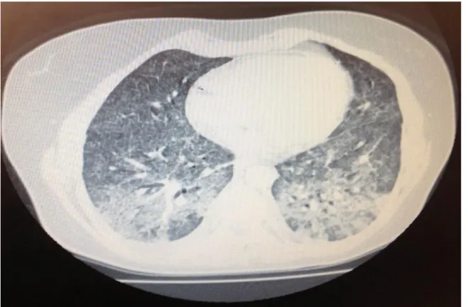 Figura  2:  Tomografia  computadorizada  de  tórax  demonstrando  pneumopatia  bilateral  com  aspecto  de  distribuição  miliar,  além de linfonodomegalia mediastinal
