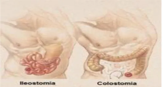 Figura 7- Localização da colostomia e ilestomia 
