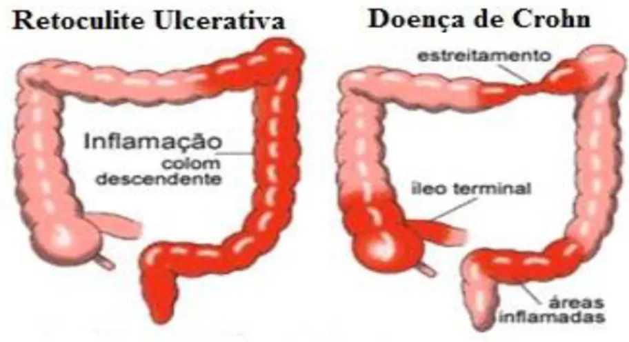 Figura 8 - Locais de manifestação da Doença de Crohn e Retocolite Ulcerativa Inespecífica 