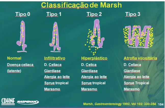 Figura 6. Classificação de Marsh  HLA 