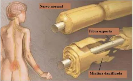 Figura 3  –  Dano a bainha de mielina 