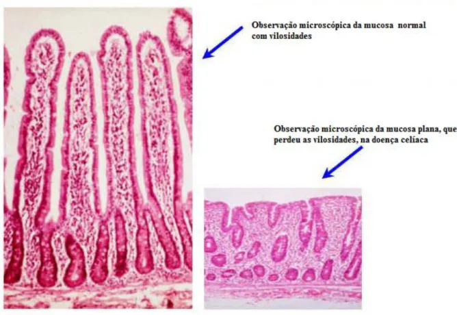 Figura 4  –  Alterações da mucosa do intestino delgado na doença celíaca  Fonte: http://www.medfoco.com.br/doenca-celiaca-sintomas-e-tratamento/ 