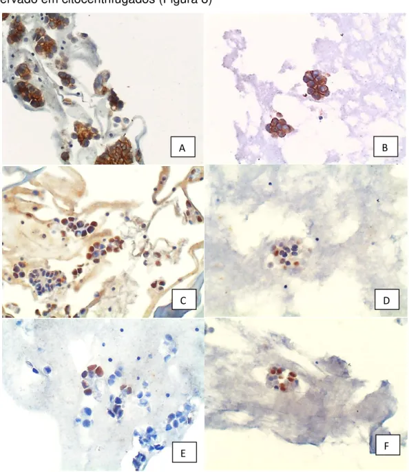Figura  8.  (A)  e  (B)  imunocitoquímica,  expressão  de  MOC-31,  200X.  Agrupamentos  de  adenocarcinoma  com  células  coradas  em  marrom  no  citoplasma e  membrana