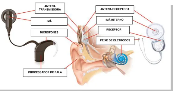 Figura 2. Unidades do componente externo do Implante Coclear.  