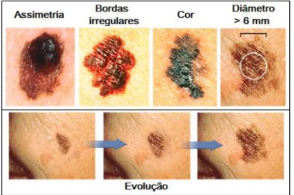 Figura 5. Características ABCDE para identificação de uma lesão como sendo melanoma. 