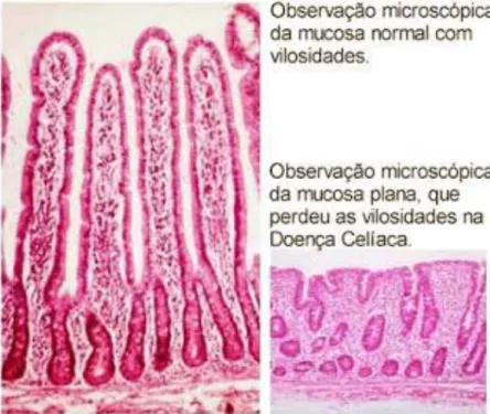 Figura  3: Observação da mucosa do intestino sadio e do intestino celíaco. Fonte:  Surfando  na Fibromialgia