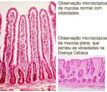 Figura 2: Observação da mucosa do intestino sadio e do intestino celíaco. Fonte: Surfando na  Fibromialgia