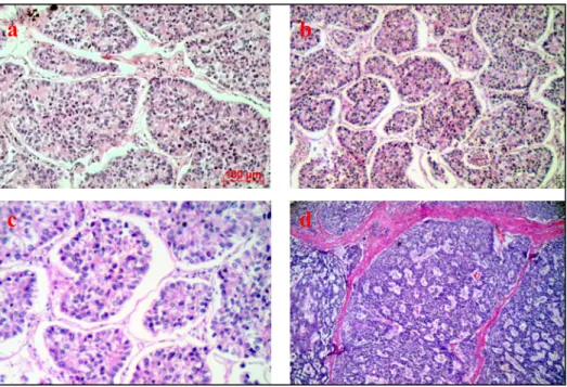 Figura 1 - Aspecto histológico de um tumor neuroendócrino. H&amp;E. a e b, carcinóide brônquico, objetiva  de 10x; c, objetiva de 20x; d, carcinoma neuroendócrino pulmonar, objetiva de 10x