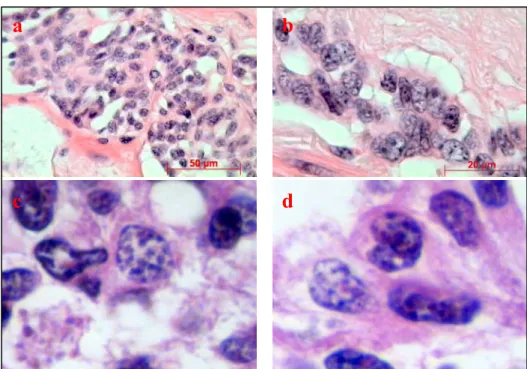 Figura 2 - Carcinoma neuroendócrino em reto. Aspecto nuclear  de um tumor neuroendócrino