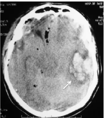Figura  4  Imagem  de  tomografia  computadorizada  de  crânio  evidenciando  contusão  hemorrágica  em  lobo frontoparietal à esquerda (seta) e tumefação cerebral difusa em ambos os hemisférios cerebrais