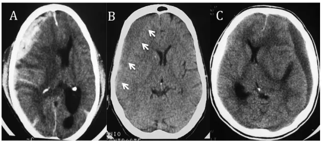 Figura 6 Imagem de tomografia computadorizada de crânio evidenciando hematoma subdural agudo  (A), subagudo – setas brancas (B) e crônico (C)