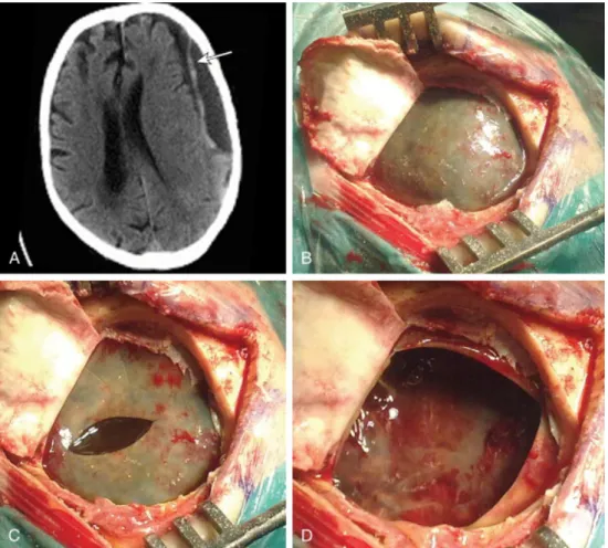 Figura  10  Imagens  de  uma  craniotomia  para  drenagem  de  hematoma  subdural  crônico  (HSDC):  (A)  Imagem  de  tomografia  computadorizada  de  crânio  evidenciando  HSDC  do  tipo  laminar;  (B)  Imagem  da abertura da dúra-máter, com visualização 