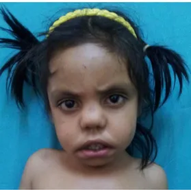 Figura 10: paciente 1 com seis anos origem étnica da Índia 