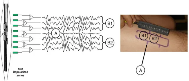 Figura 2.13 - Arranjo linear de eletrodos e ilustração dos sinais captados com o filtro espacial  duplo diferencial