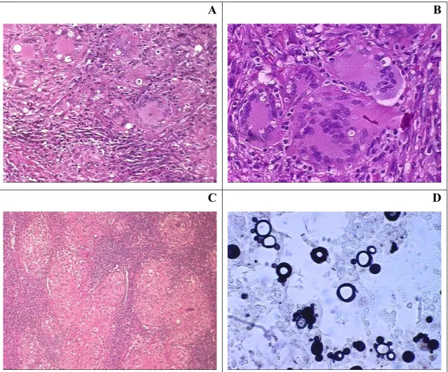 Figura 1: Fotomicrografia de lesões de pacientes com paracoccidioidomicose do tipo pulmonar  (A e B) apresentando granulomas com presença de células gigantes multinucleadas e leveduras  de fungo no seu interior; granulomas epitelióides confluentes de linfo