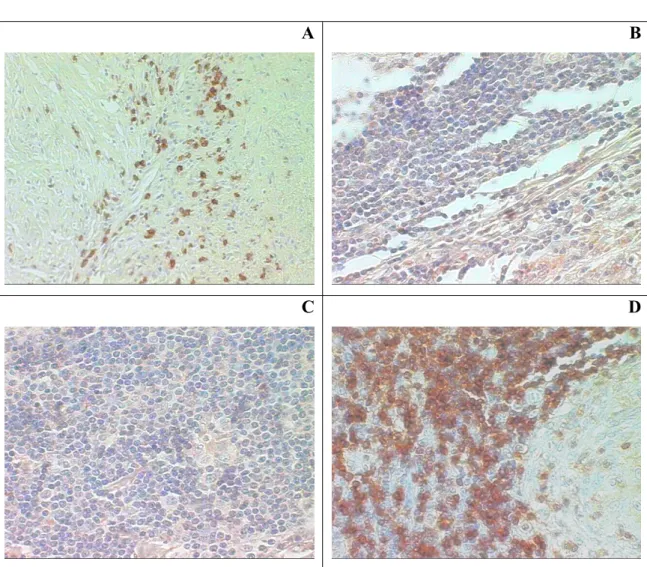 Figura 6: Análise imuno-histoquímica dos granulomas das lesões de pacientes com sarcoidose,  para os marcadores CD8 (A), CD25 (B), CTLA-4 (C) e CD3 (D)