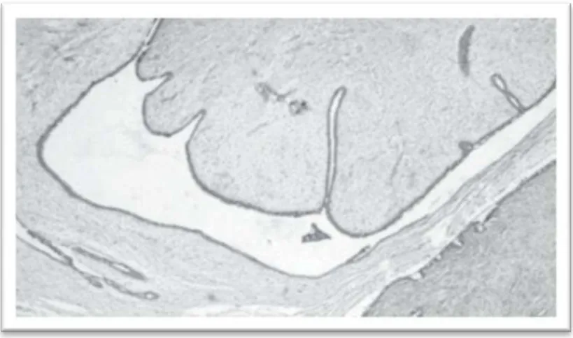 Figura 2. Área com aspeto filóide - like em um fibroadenoma. O aspeto intracanalicular exagerado e  foliáceo da lesão, típico do tumor filóide, contrasta com a baixa celularidade estromal (25x) (Imagem 