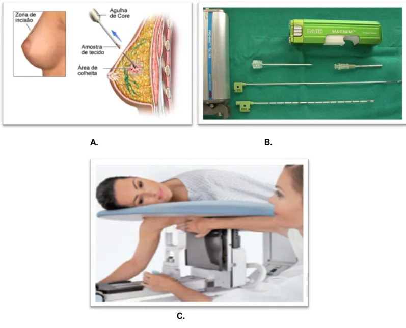 Figura 6  –  A. Técnica de Core Biópsia; B.  Pistola, passador e agulha de Core Biópsia; C