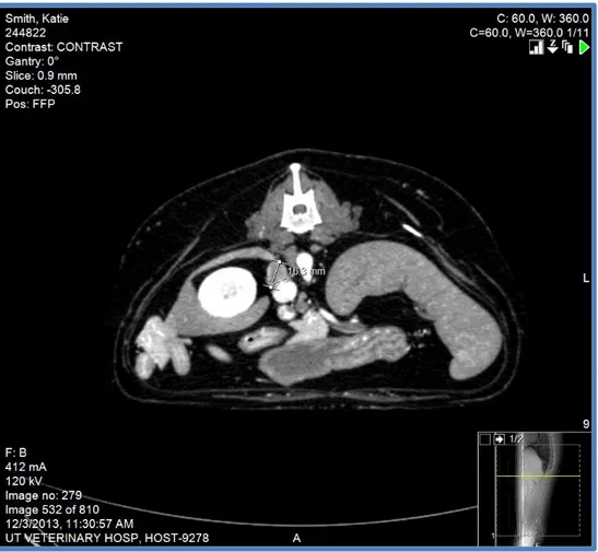 Fig.  7  –  Right  adrenal  mass  that  later  confirmed  to  be  an  adrenocortical  carcinoma (~ size 1,63 cm)