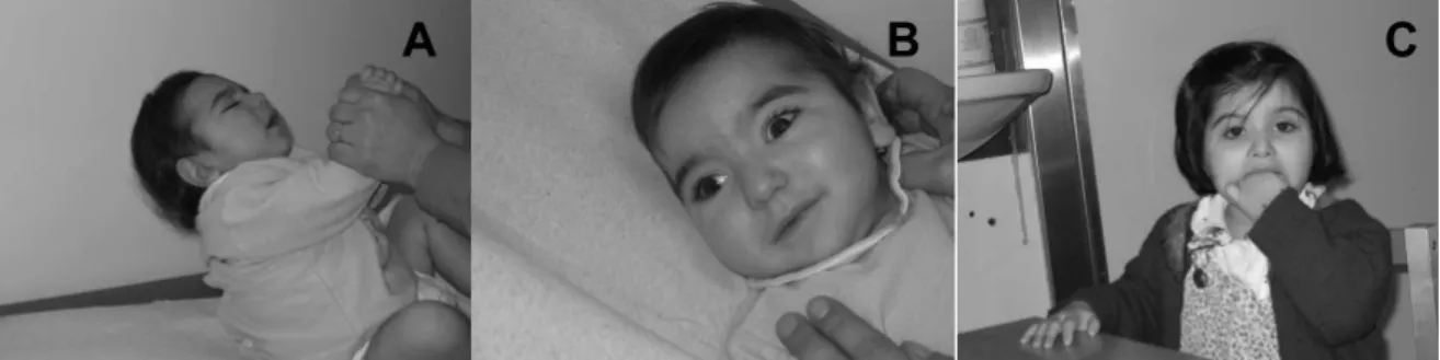 Figure 3 – Brother and sister with the same MECP2 mutation. The male (A, B) had a severe encephalopathy since birth, with major hypotonia, microcephaly and dysmorphic features