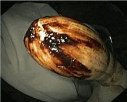 Figura  3  -  Melenas (toque rectal). 