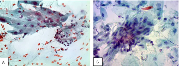 Figura  5  -  Esfregaços  cervicovaginais  convencional  (A)  e  em  base  líquida  (B)  exibindo  células  epiteliais escamosas com alterações reparativas