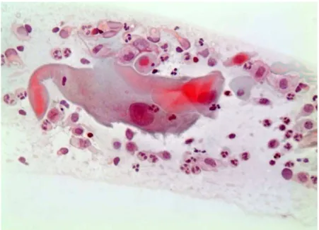 Figura 7 - Esfregaço cervicovaginal convencional exibindo macrócito com policromasia citoplasmática