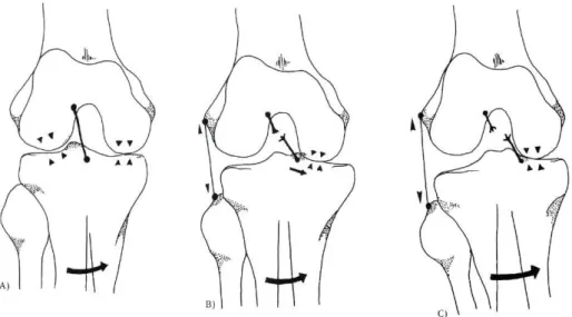 Fig. 6 — A rotura do LCA causa translação interna da tíbia e varização do joelho por distensão das estruturas externas