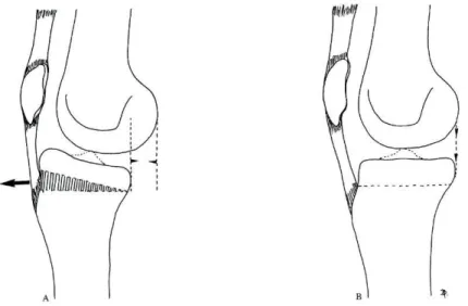 Fig. 12 — A: Exagero da inclinação posterior dos pratos tibiais e consequente subluxação anterior da tíbia