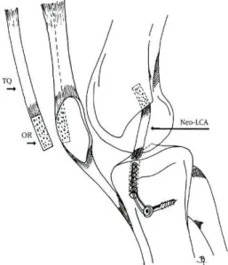Fig. 30 — Técnica de Blauth. Neo-LCA reconstruído com tendão quadricipital (TQ)  e com osso rotuliano (OR) num dos extremos