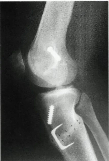 Fig. 41 — RX de perfil. Sinais de reconstrução do LCA e de osteotomia anti-recurvatum 