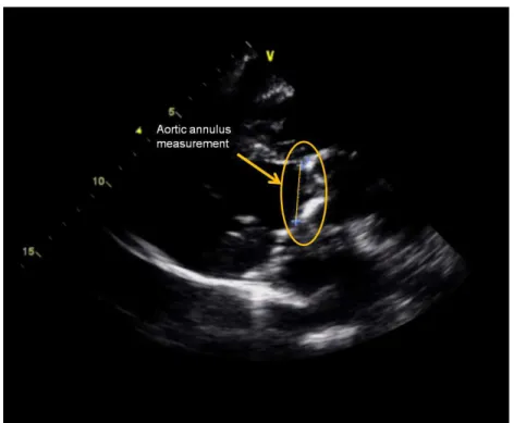 Figure 10.2 Transthoracic echocardiography parasternal long-axis view for measurement of aortic annular dimension.