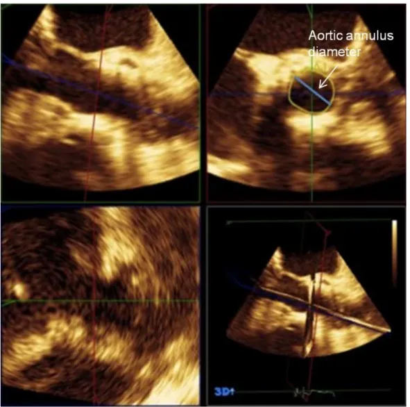 Figure 10.3 3D Transesophageal echocardiography assessing shape and measurements of the aortic annulus.