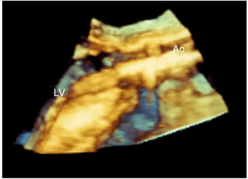 Figure 10.6 3D Transesophageal echocardiography showing the catheter and the balloon through the native aortic valve.