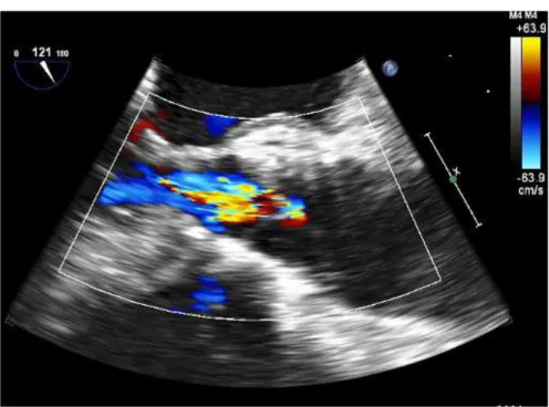Figure 10.7 2D transesophageal echocardiography showing aortic prosthesis central regurgitation.