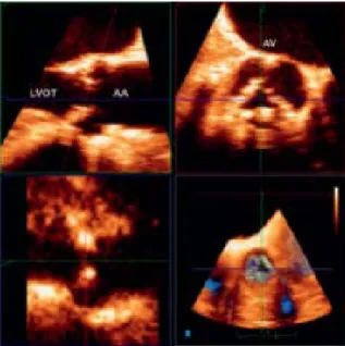 Figure  3.  Post-processing  of  3D  volumetric  acquisition  using multiplanar reformatting or MPR showing valve anatomy and geometry of the LVOT