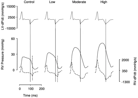 Fig. 3. Effects of right ventricular afterload elevations on pressure fall. Left ventricular dP/dt (LV-dP/dt, upper panels), right ventricular  (RV) pressure (bottom panels, solid lines) and RV-dP/dt (bottom panels, dashed lines) are displayed for the cont