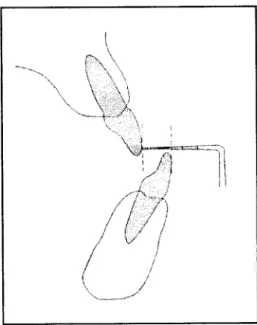 Figura 3 - Medida da sobremordida horizontal invertida 