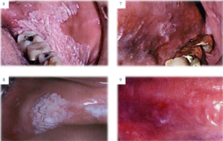 Figura 6: Leucoplasia homogénea – notar as fissuras pouco profundas que se espalham um pouco por toda a lesão