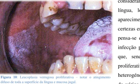 Figura  10:  Leucoplasia  verrugosa  proliferativa  –   notar  o  atingimento  difuso de toda a superfície da língua e mucosa jugal.