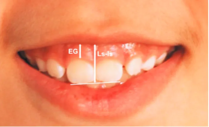 Figura 5  -  Fotografia frontal com as medidas da exposição de gengiva no sorriso (EG) e exposição de  incisivos superiores no sorriso (ls- is) dados em milímetros.