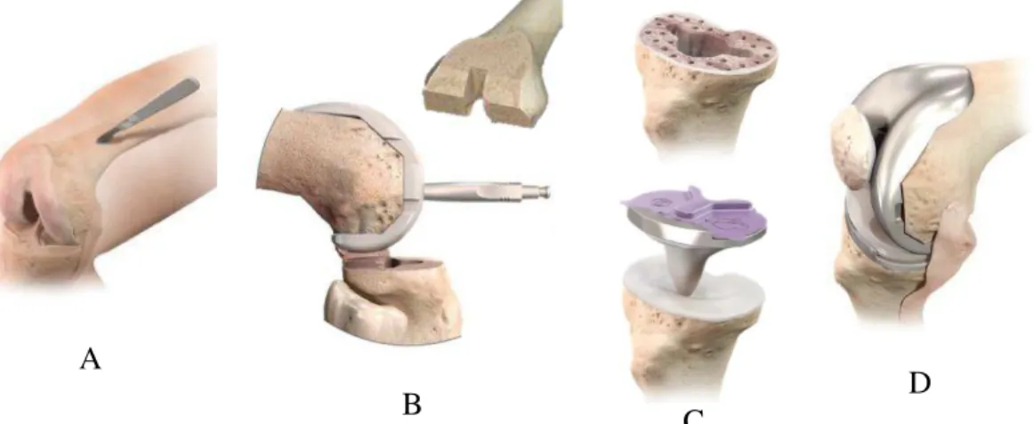 Figura 5  –  A: joelho exposto em flexão; B: colocação da componente femoral; C: colocação da  componente tibial; D: aspecto final com o joelho em flexão (Depuy Synthes, 2015)