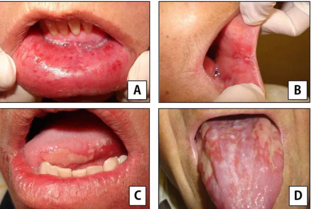Figura 2. Imagens de arquivo pessoal autorizadas pelo paciente mostrando a  evolução da mucosite oral, segundo a classificação da Organização Mundial de  Saúde (OMS, 1979)