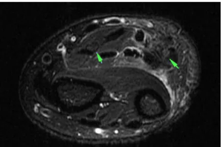 Figura  1:  As  setas  indicam  o  aspecto  radiológico  de  imagem  obtida  por  RM  1.5T  com  corte  axial  ponderado  em  T2  (T2-weighted),  de  punho  sem  evidência  de  lesão  do  nervo  mediano  (a  esquerda)  ou  do  nervo  ulnar  (a  direita),  